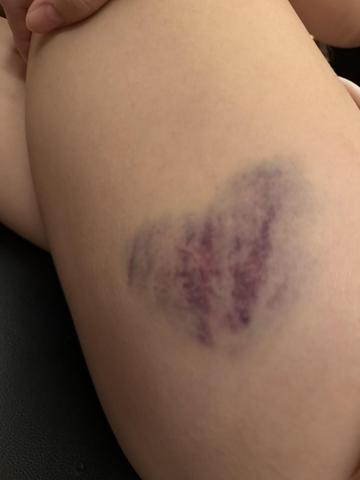 ハート型のアザかわいい((o(｡･ω･｡)o))